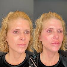 Leeza Edmundson Smith, Aesthetic Injector (@myinjectorleeza) • Facebook