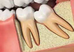 Wisdom Teeth Cambridge Burwell Dental Surgery