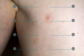 That's called the herald patch or. Pityriasis Rosea