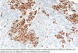 In most cases, complete surgical excision of the tumor should be carried out immediately following a sentinel lymph node biopsy procedure. Pathology Outlines Merkel Cell Carcinoma