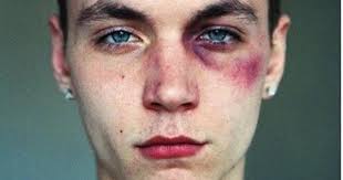 Pin On Wound
