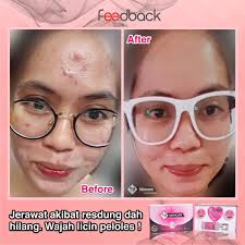 Kecutkan jerawat tanpa tinggalkan parut dengan hanya guna timun dan serbuk kunyit je! Tips Hilangkan Jerawat T9 Skincare