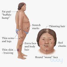 Cushing Syndrome What The Symptoms Are How To Treat Buoy