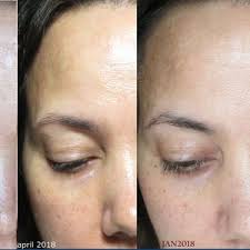 Both are amazing treatments for lines and wrinkles. Retin A Reviews Was It Worth It Realself