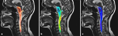 Mri cervical spine and mri shoulder for pain indications. Role Of Diffusion Tensor Mr Imaging In Degenerative Cervical Spine Disease A Review Of The Literature Springerlink