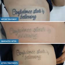 After completing laser tattoo removal for four sessions, the first butterfly we worked on was almost completely gone! Tattoo Removal Before And After Photos Goodbye Tattoos 1300 745 074