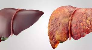 Image result for 4 à¤à¤à¤à¥ à¤®à¥à¤ à¤²à¤¿à¤µà¤° à¤à¥ à¤¸à¤¾à¤°à¥ à¤à¤à¤¦à¤à¥ à¤à¥ à¤¬à¤¾à¤¹à¤° à¤¨à¤¿à¤à¤¾à¤²à¥