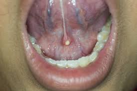 Image result for Sialolithiasis