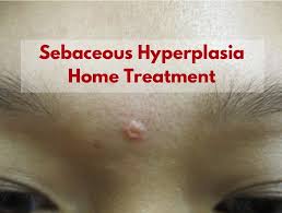 Get rid of sebaceous glands on face. How To Treat Sebaceous Hyperplasia Sebaceous Hyperplasia Removal