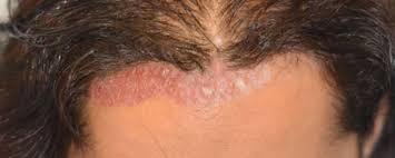 Image result for Seborrheic Dermatitis