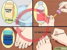 No, vicks vapor rub does not cure toenail fungus. 3 Ways To Heal An Ingrown Toenail Wikihow