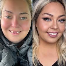 I seriously can't stop smiling thanks to Press On Veneers by Brighter Image  Lab ! I have two missing front teeth and felt so insecure about my smile  and now I've got