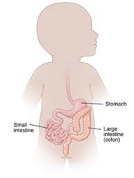 Image result for Intestinal Malrotation