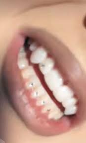 A dentist is trained to diagnose, treat, and prevent diseases of the gums, teeth, and jaw. Alabama Barkers Tooth Gems In 2021 Alabama Barker Barker Teeth