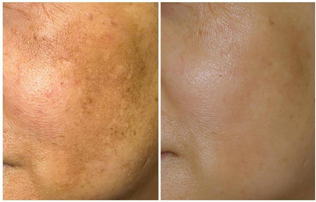 MELASMA TREASTMENT product image