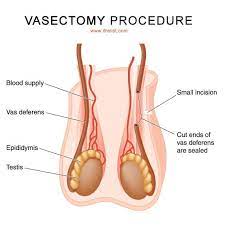 Vasectomy Can Be A Major Step In A Man S Life See How This Procedure Is Performed Vasectomy Reversal Vasectomy Contraception Methods