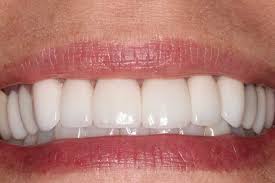 Composite veneers are a quick and affordable option. Veneer Longevity Christopher Cooley Dds