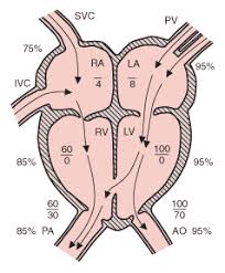 Ventricular Septal Defect Vsd Pediatrics Msd Manual