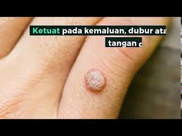 Serviks kanseri gelişimindeki risk faktörleri nelerdir? Hpv Human Papillomavirus Penyebab Gejala Dan Ubat Doctoroncall