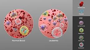 The three main types of blood and bone marrow cancer are leukemia, lymphoma and myeloma: Leukemia Wikipedia