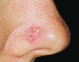 View photos of basal cell carcinoma, squamous cell carcinoma, melanoma, and kaposi sarcoma. Skin Cancer Cancer Council Western Australia