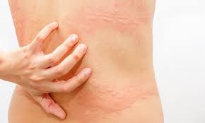 Kudis atau scabies adalah masalah kulit yang disebabkan oleh tungau mikroskopis. Bercak Merah Di Kulit Bikin Gak Pede Kenali Tanda Dan Cara Mengobatinya Cermati Com