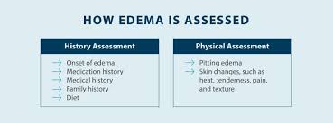 Image result for Edema Exam