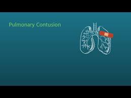Image result for Pulmonary Contusion
