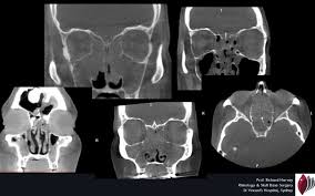 Image result for Sinusitis Prediction Rule