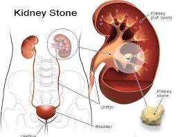 Pin On Gout Causes
