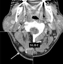 In case of occipital lymph nodes, the most likely culprit in cancer is a squamous cell carcinoma of the scalp. Nobleresearch