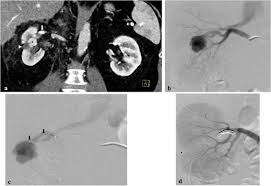 Sie erhöhen jedoch die blutungsneigung. Irescue Interventional Embolization Of Renal Arteries After Surgical Or Traumatic Injury With Hemorrhage Sciencedirect