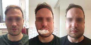 Meine Weisheitszahn Op Erfahrungen Weisheitszahn Op Net