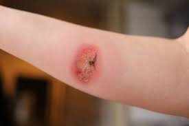 Image result for Wound
