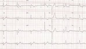 Kalau kemiringannya 0 (gambar a), maka disebut horizontal. Penggunaan Kriteria Sgarbossa Dalam Diagnosis Ima Dengan Lbbb Alomedika