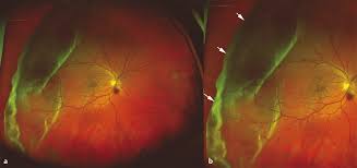 The longer retinal detachment goes untreated, the greater your risk of permanent vision. Giant Retinal Tear Ento Key