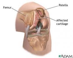 Pin On Chondromalacia