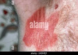 Image result for Erythrasma