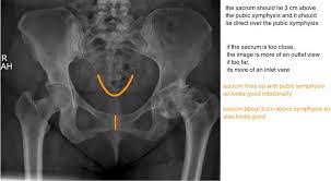 Image result for Hip XRay