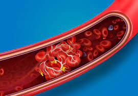 Clotting is normal, but clots can be dangerous when they do not dissolve on their own. Should You Be Worried About Blood Clots With Covid 19 Health Essentials From Cleveland Clinic