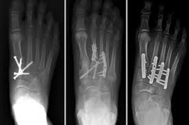Image result for Foot Fracture
