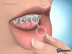 You can remove the wax by taking it off with your fingers or. 9 How To Use Orthodontic Wax Ideas Orthodontics Wax Braces Tips