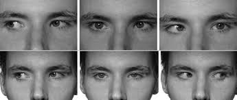 Dense amblyopia: should we consider encouraging long-term continued  refractive correction of the amblyopic eye? A case of gettin