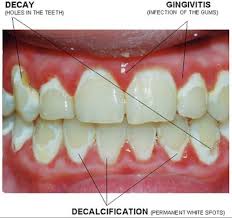 Why flossing is important when you're wearing braces. Pin On Teeth