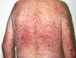 Nasonex (mometasone) is a steroid. Steroid Akne Bilder Dermatly Com Ihre Haut Website