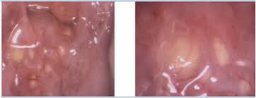 Image result for Colposcopy Findings