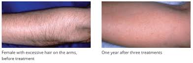 When shaving or waxing your body hair becomes a pain or a chore, and your busy lifestyle leaves little time to spare, laser hair removal can provide the perfect solution. Laser Hair Reduction Dermatologist In Atlanta Ga Georgia Skin Specialists