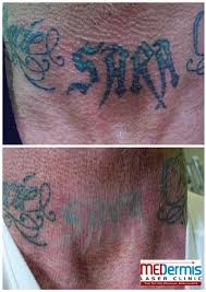 The marriage lasted for the undertaker used to have a visible tattoo in the front part of his neck with the first name of his wife on it. Rethinking Ink Removing Your Ex S Name Medermis Laser Clinic