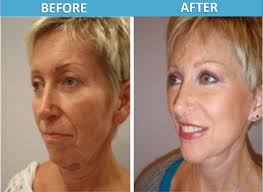 The surgery itself can take anywhere from 45 minutes to 2 hours or more. Weekend Mini Face Lift Before After Photos Center For Cosmetic Surgery In San Diego