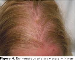 В этому случае необходима консультация эндокринолога 4. Pdf Two Fatal Cases Of Dermatomyositis And Ovarian Cancer Semantic Scholar